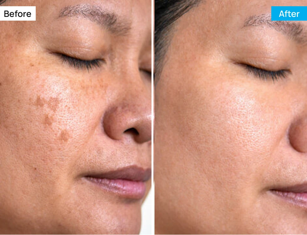 Before After Image